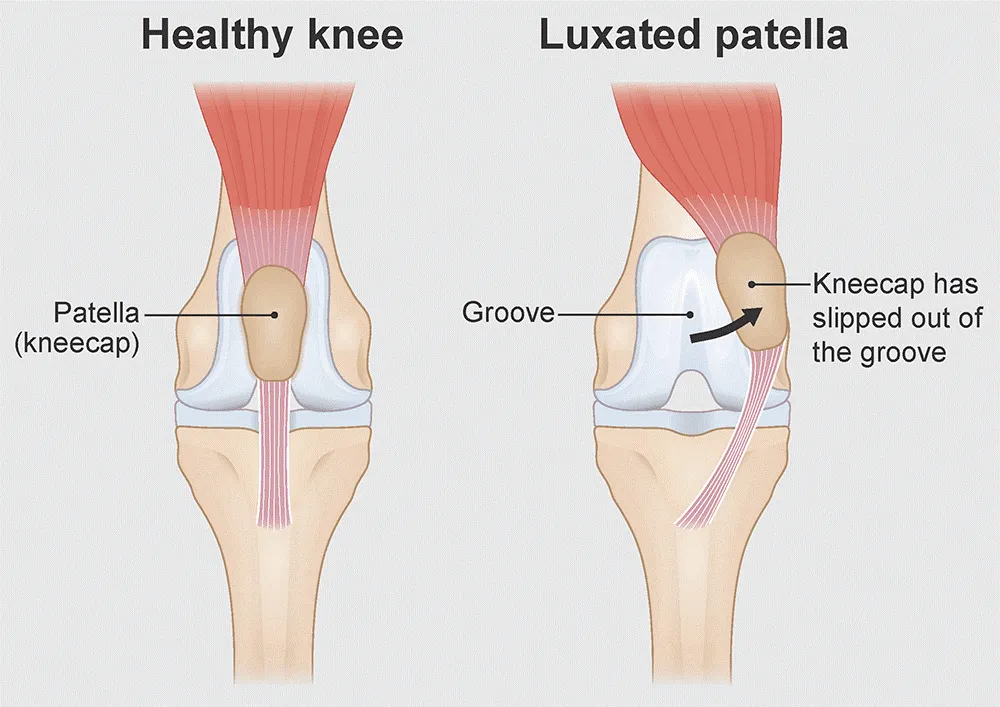 Illustration comparing normal patellar tracking with a luxating kneecap