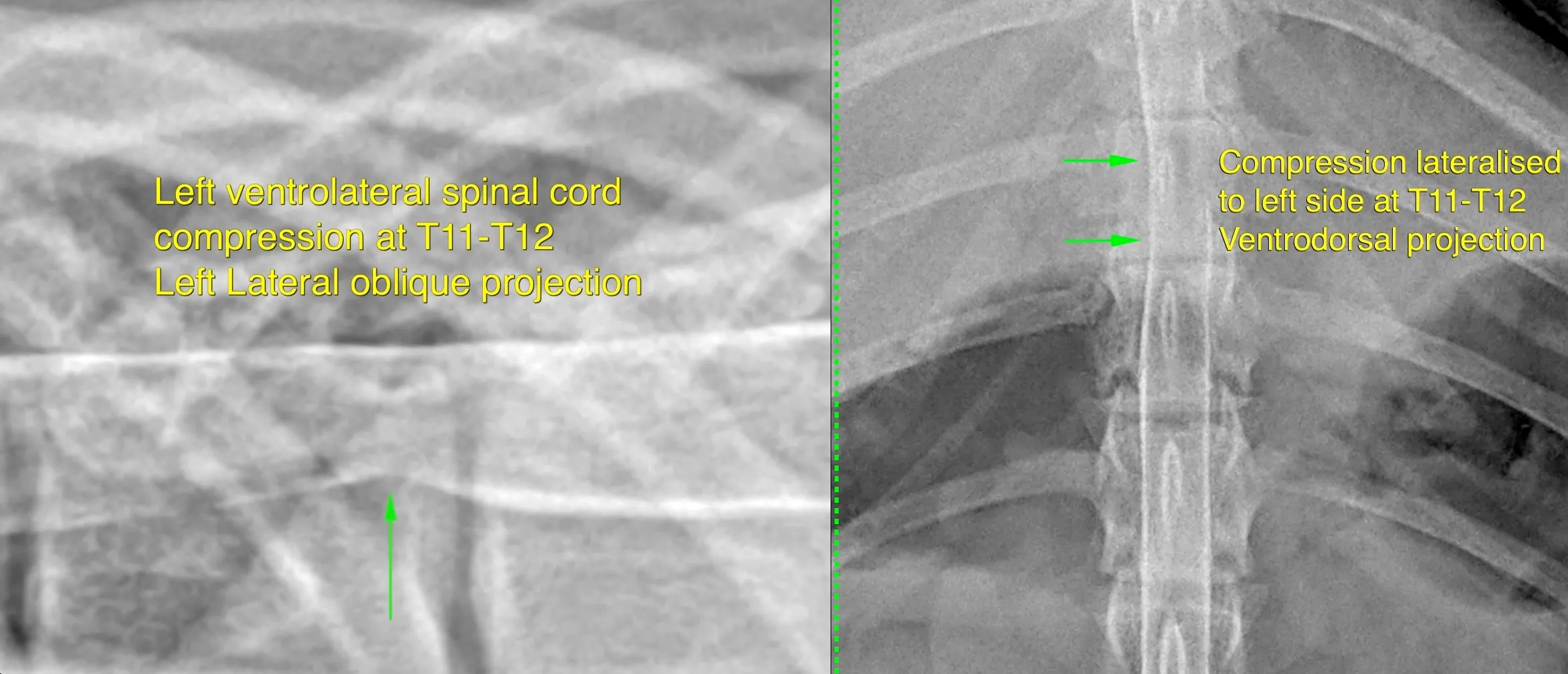Spinal imaging used to assess intervertebral disc disease
