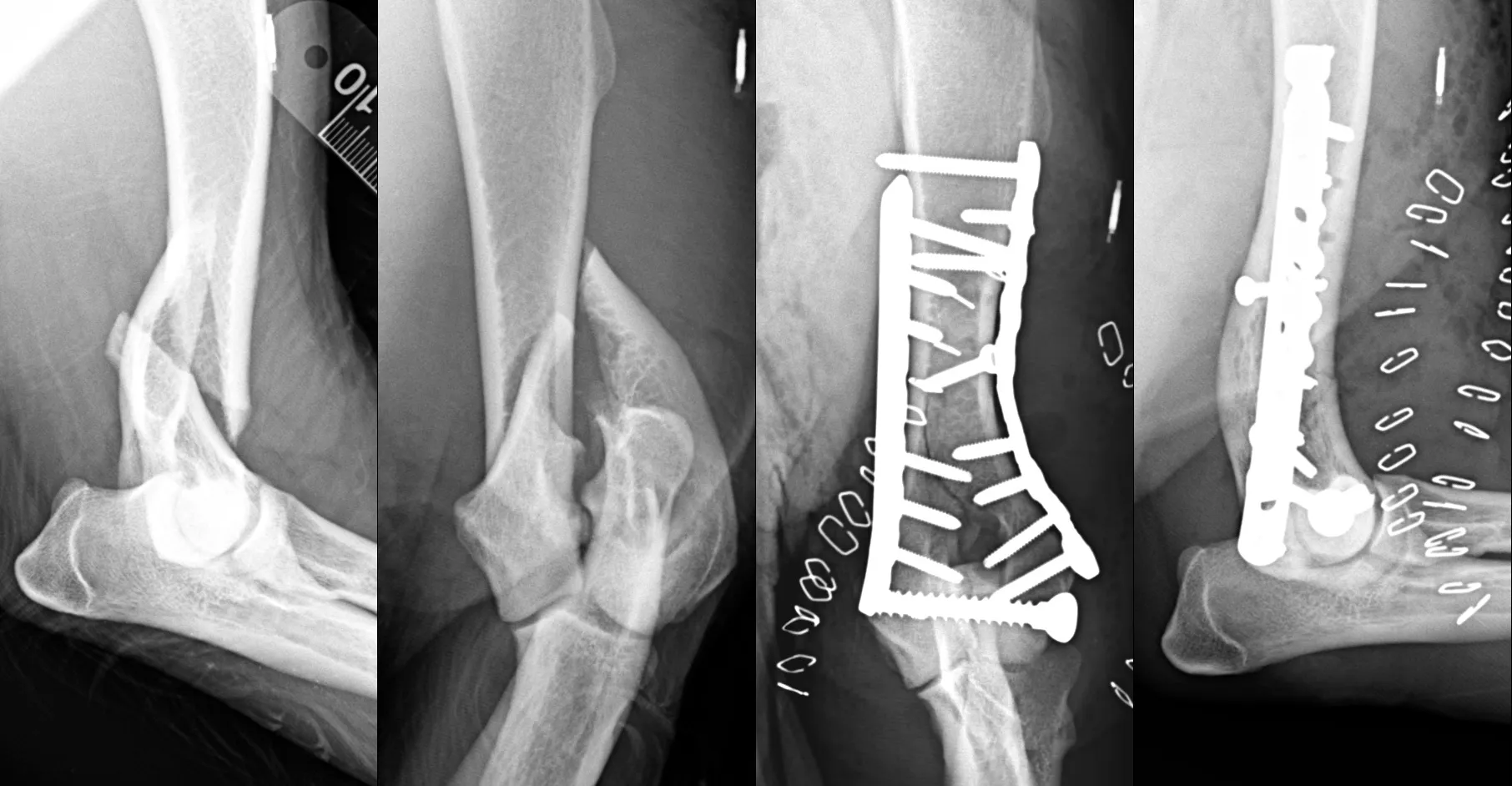 Pre-operative and post-operative radiographs of a repaired fracture