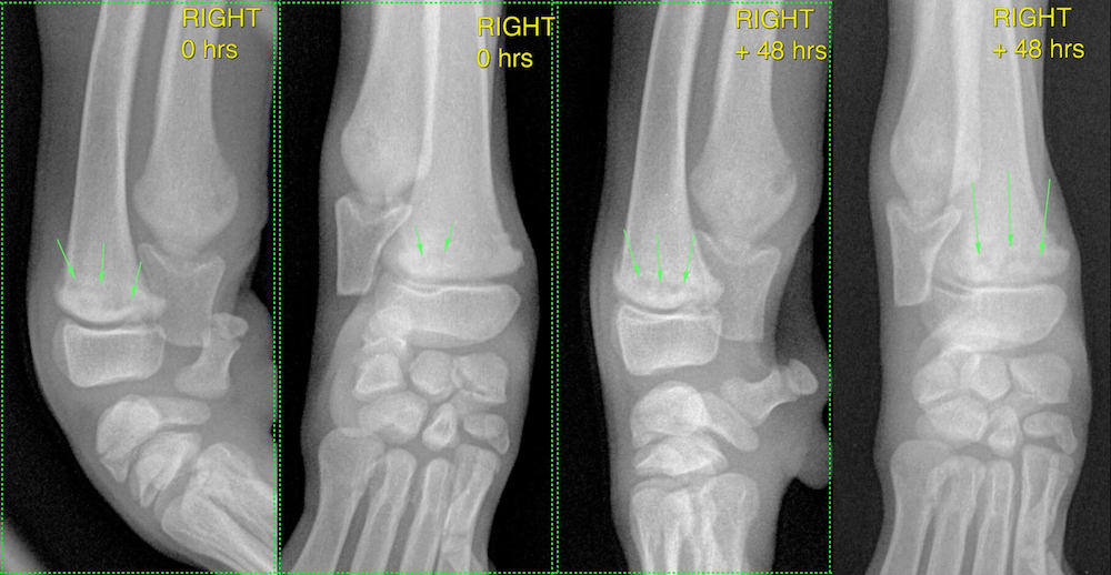 Hypertrophic osteodystrophy progression right carpus