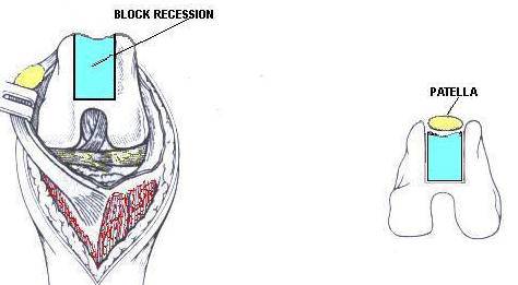 Diagrammatic representation of a rectangular block recession trochleoplasty