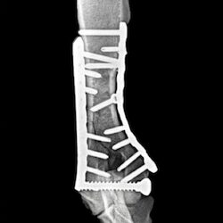 Y-fracture-double-LCP