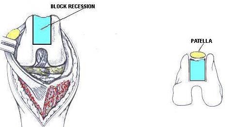 block recession